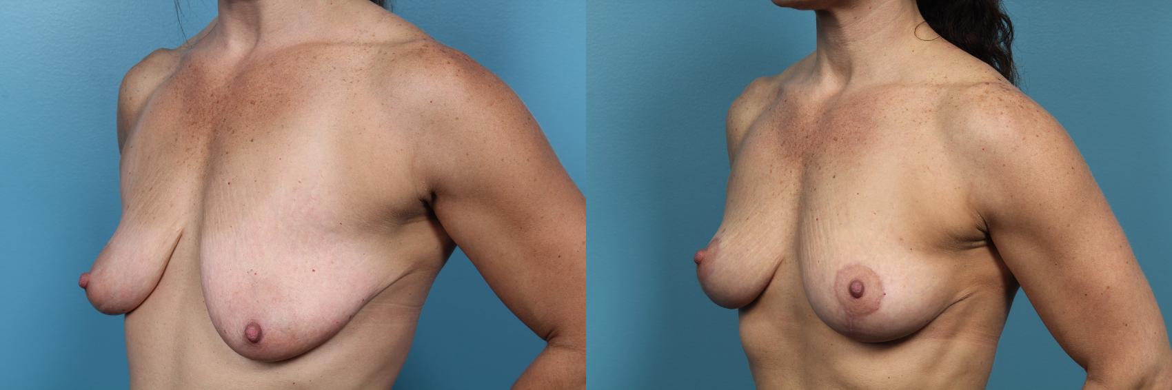 Before & After Breast Lift Case 66 View #2 View in Portland, OR