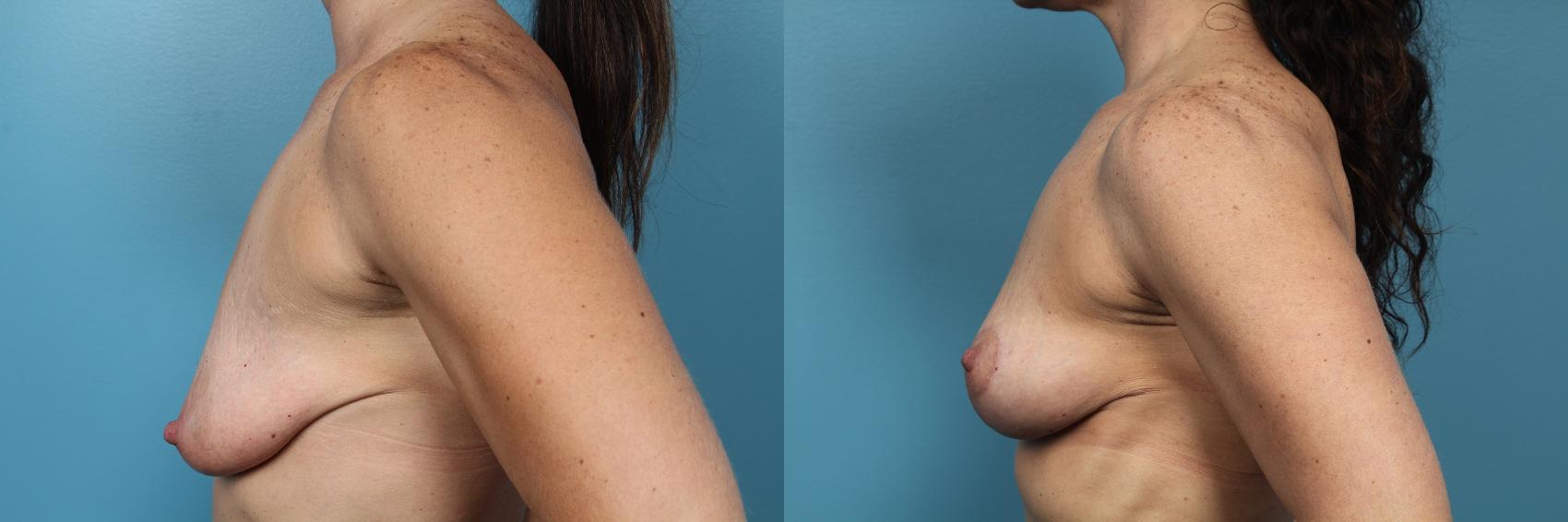 Before & After Breast Lift Case 66 View #3 View in Portland, OR
