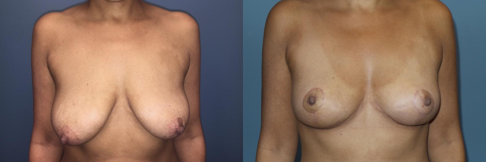 Before & After Breast Lift Case 90 View #1 View in Portland, OR