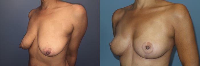 Before & After Breast Lift Case 90 View #2 View in Portland, OR