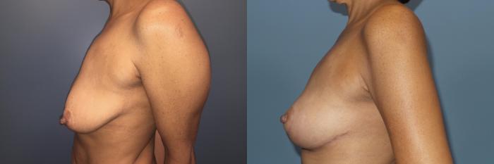 Before & After Breast Lift Case 90 View #3 View in Portland, OR