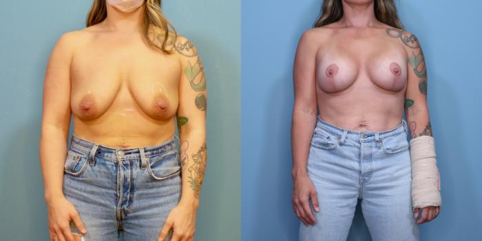 Before & After Breast Lift with Implants Case 359 Front View in Portland, OR