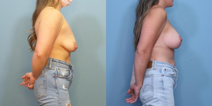 Before & After Breast Lift with Implants Case 359 Right Side View in Portland, OR