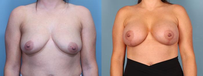 Before & After Breast Lift with Implants Case 402 Front View in Portland, OR