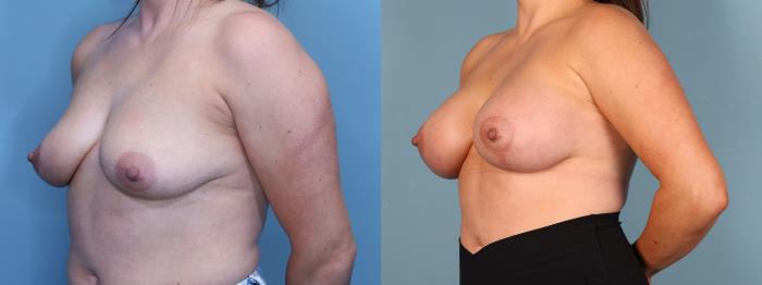 Before & After Breast Lift with Implants Case 402 Left Oblique View in Portland, OR