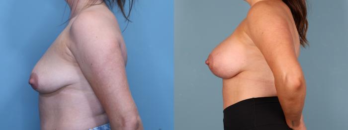 Before & After Breast Lift with Implants Case 402 Left Side View in Portland, OR