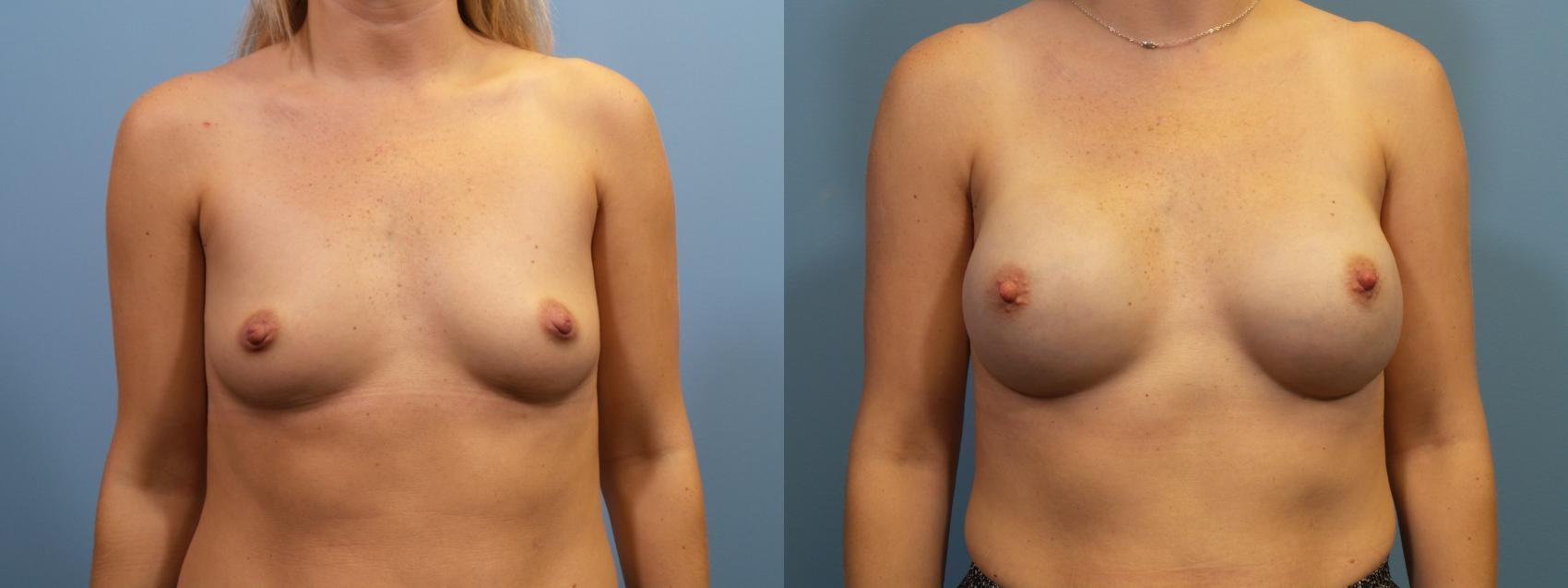 Before & After Breast Reconstruction Case 111 View #1 View in Portland, OR