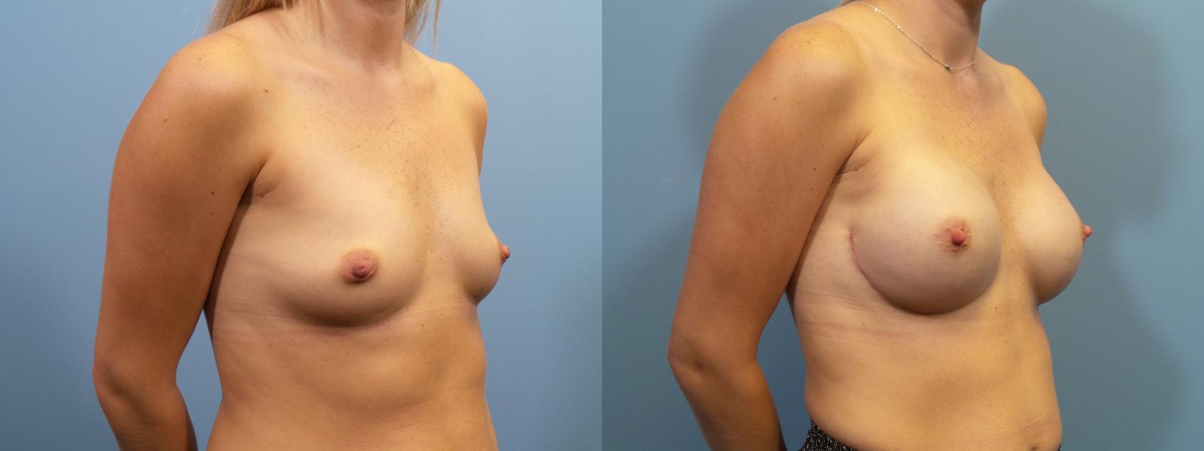 Before & After Breast Reconstruction Case 111 View #2 View in Portland, OR