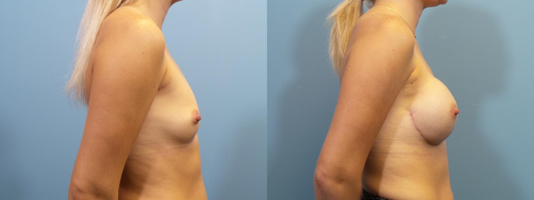 Before & After Breast Reconstruction Case 111 View #3 View in Portland, OR