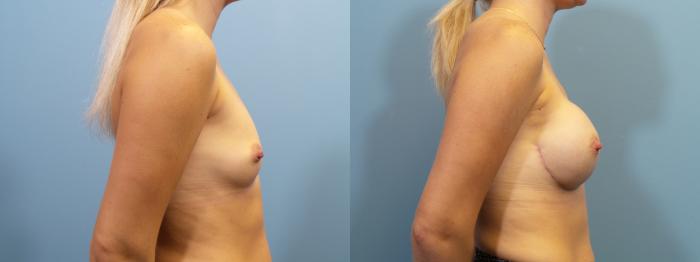 Before & After Breast Reconstruction Case 111 View #3 View in Portland, OR