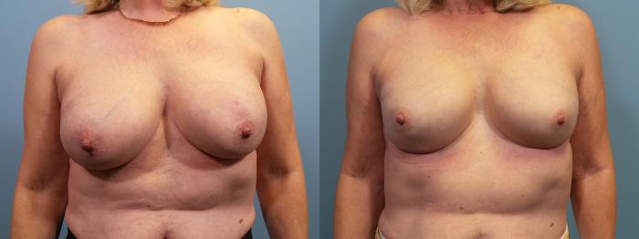 Before & After Breast Reconstruction Case 121 View #1 View in Portland, OR