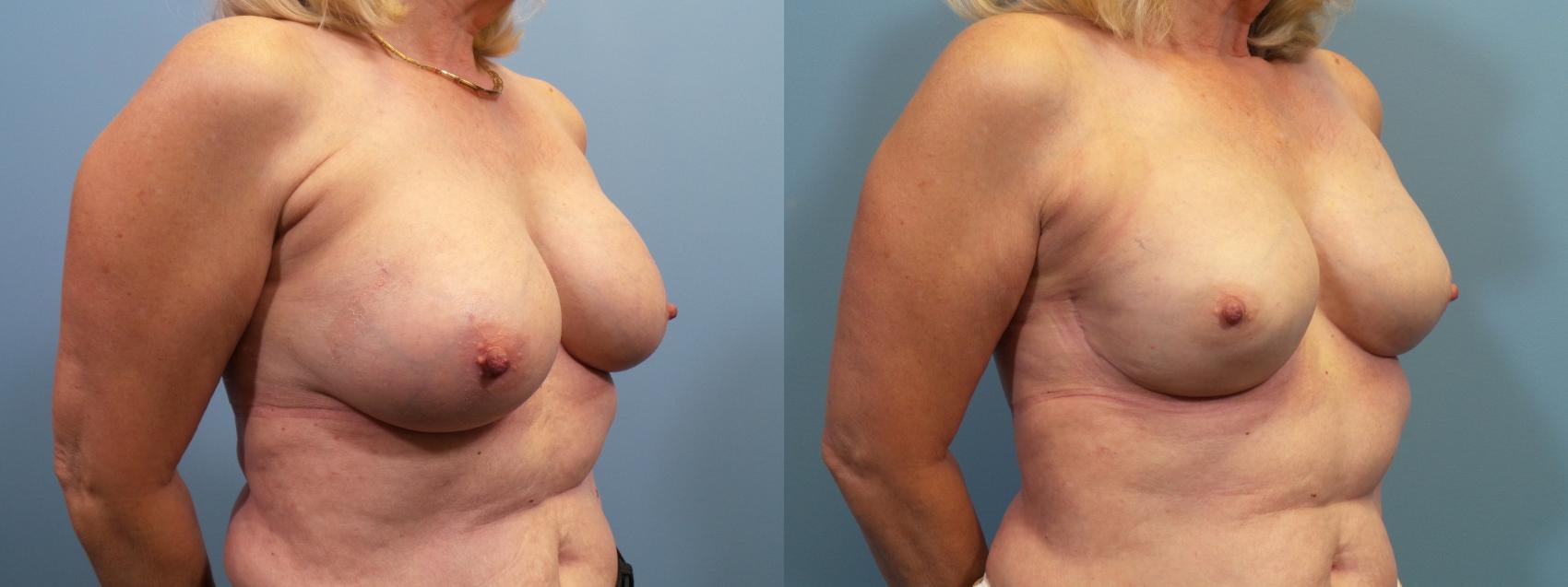 Before & After Breast Reconstruction Case 121 View #2 View in Portland, OR