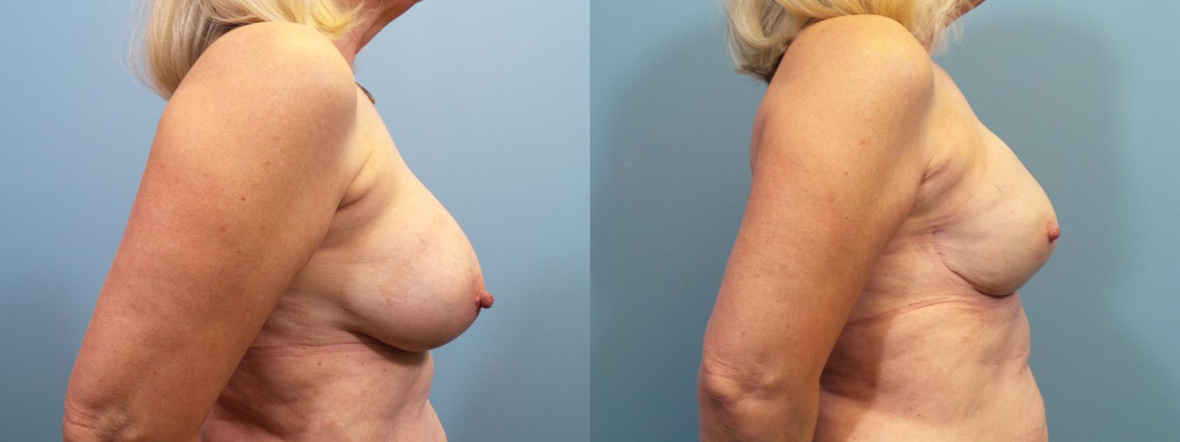 Before & After Breast Reconstruction Case 121 View #3 View in Portland, OR