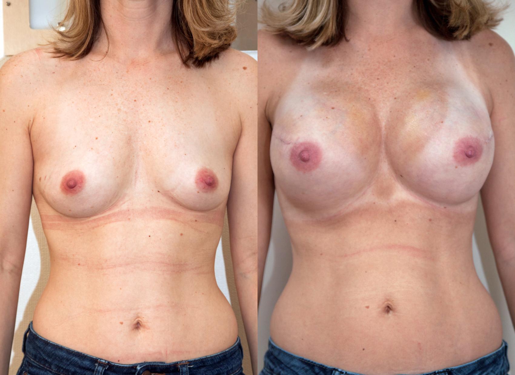 Before & After Breast Reconstruction Case 218 View #1 View in Portland, OR