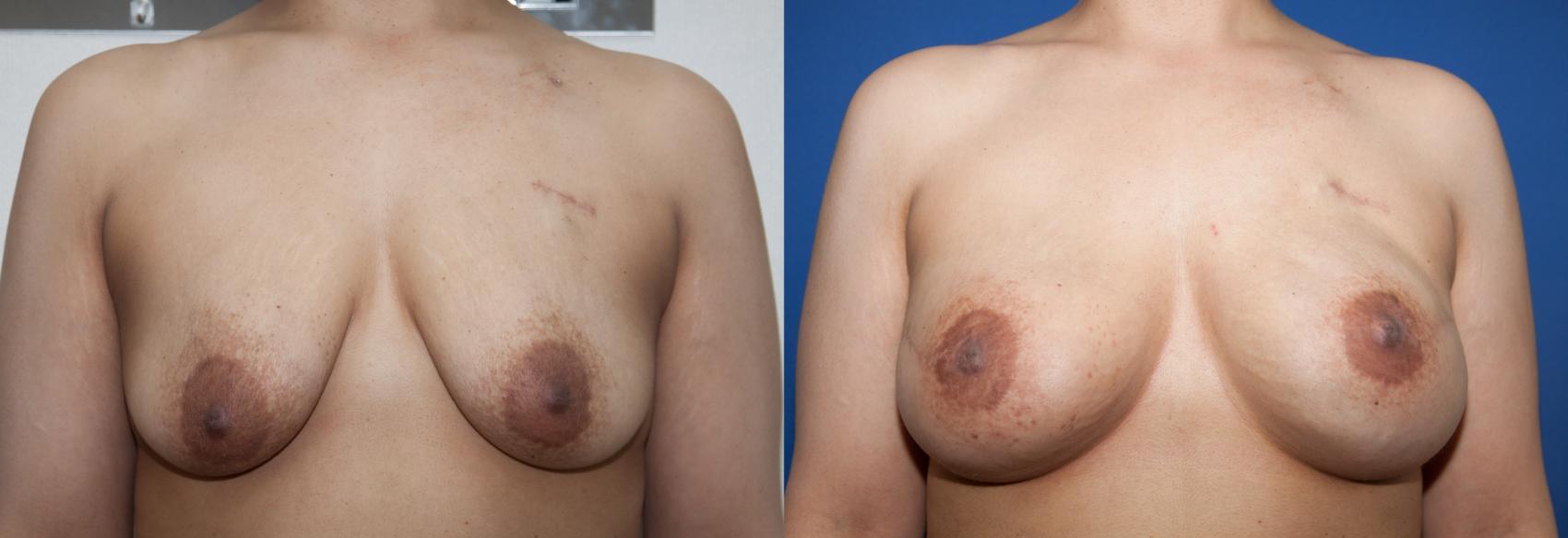 Before & After Breast Reconstruction Case 221 View #1 View in Portland, OR