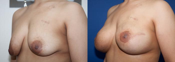 Before & After Breast Reconstruction Case 221 View #2 View in Portland, OR