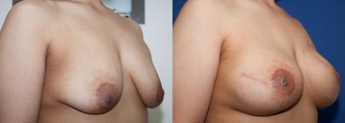 Before & After Breast Reconstruction Case 221 View #3 View in Portland, OR