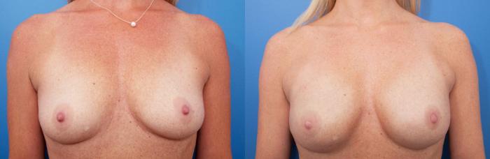 Before & After Breast Reconstruction Case 231 View #1 View in Portland, OR