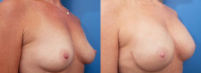 Before & After Breast Reconstruction Case 231 View #2 View in Portland, OR