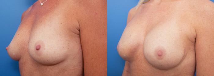 Before & After Breast Reconstruction Case 231 View #3 View in Portland, OR
