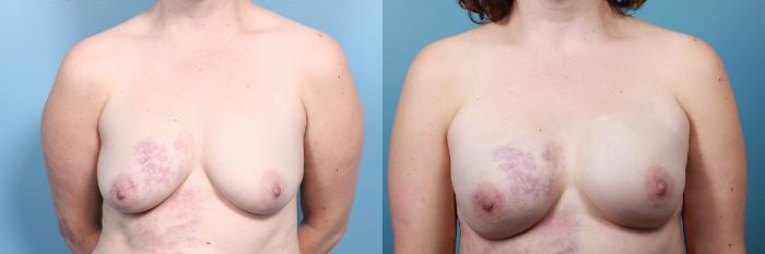 Before & After Breast Reconstruction Case 25 View #1 View in Portland, OR