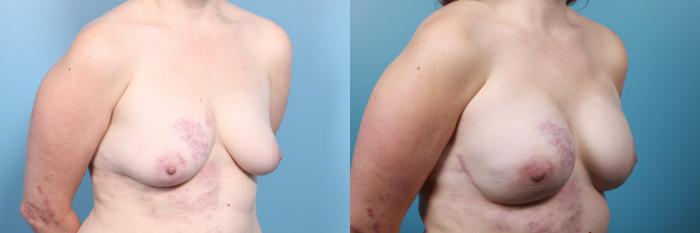 Before & After Breast Reconstruction Case 25 View #2 View in Portland, OR