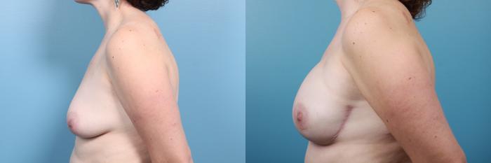 Before & After Breast Reconstruction Case 25 View #3 View in Portland, OR