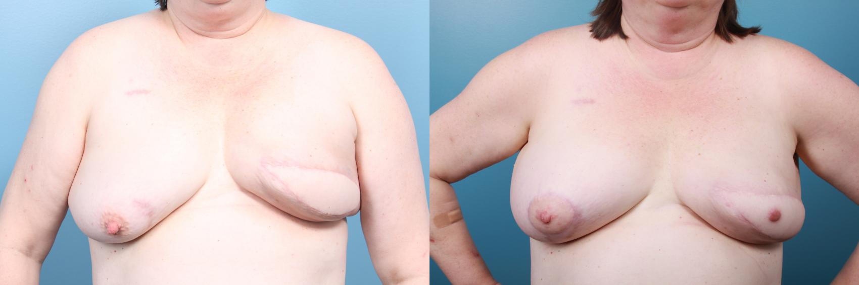 Before & After Breast Reconstruction Case 26 View #1 View in Portland, OR