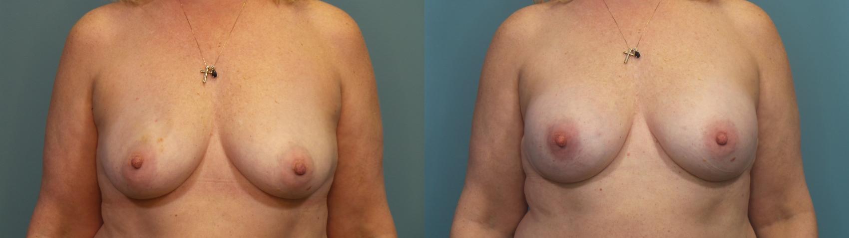 Before & After Breast Reconstruction Case 313 Front View in Portland, OR