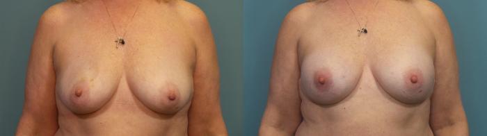 Before & After Breast Reconstruction Case 313 Front View in Portland, OR