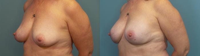 Before & After Breast Reconstruction Case 313 Left Oblique View in Portland, OR