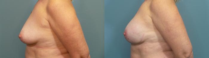 Before & After Breast Reconstruction Case 313 Left Side View in Portland, OR