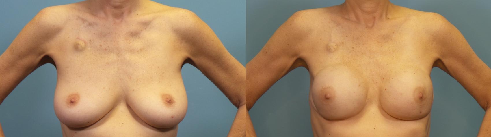 Before & After Breast Reconstruction Case 317 Front View in Portland, OR