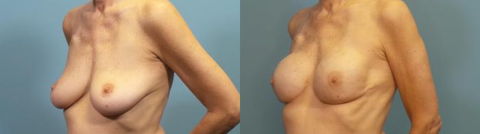 Before & After Breast Reconstruction Case 317 Left Oblique View in Portland, OR