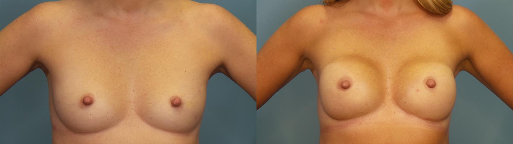 Before & After Breast Reconstruction Case 353 Front View in Portland, OR