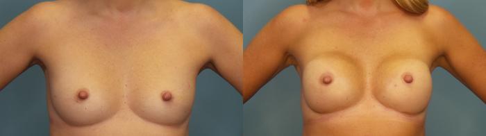 Before & After Breast Reconstruction Case 353 Front View in Portland, OR