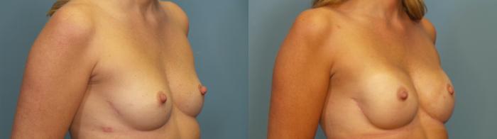 Before & After Breast Reconstruction Case 353 Right Oblique View in Portland, OR