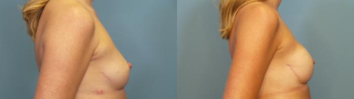 Before & After Breast Reconstruction Case 353 Right Side View in Portland, OR