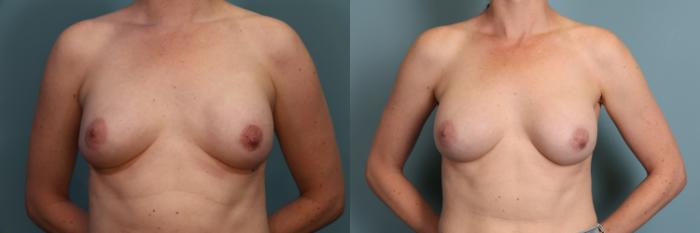 Before & After Breast Revision Case 371 Front View in Portland, OR