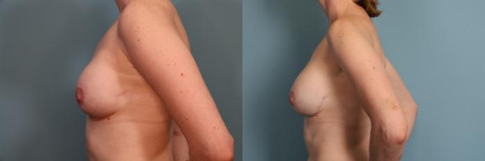 Before & After Breast Revision Case 371 Left Side View in Portland, OR