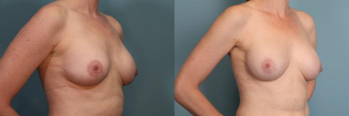 Before & After Breast Revision Case 371 Right Oblique View in Portland, OR