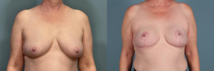 Before & After Breast Reconstruction Case 378 Front View in Portland, OR