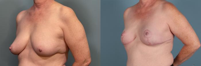 Before & After Breast Reconstruction Case 378 Left Oblique View in Portland, OR