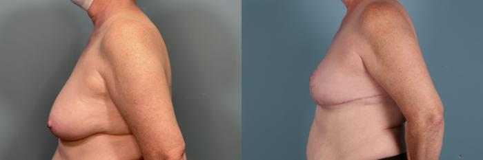 Before & After Breast Reconstruction Case 378 Left Side View in Portland, OR