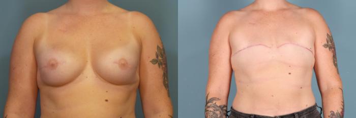 Before & After Breast Reconstruction Case 380 Front View in Portland, OR