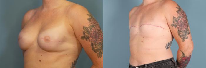 Before & After Breast Reconstruction Case 380 Left Oblique View in Portland, OR