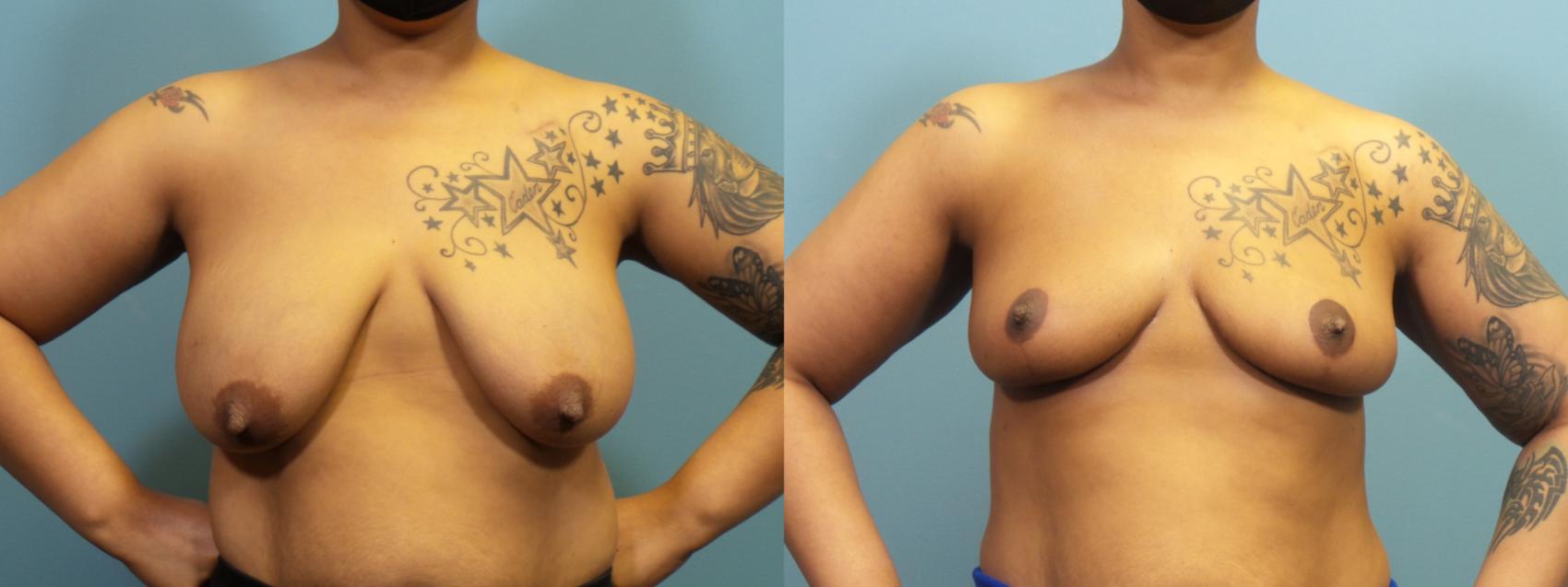Before & After Breast Reduction Case 412 Front View in Portland, OR