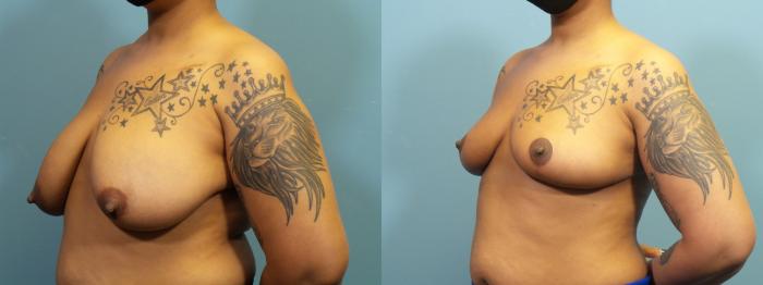 Before & After Breast Reconstruction Case 412 Left Oblique View in Portland, OR