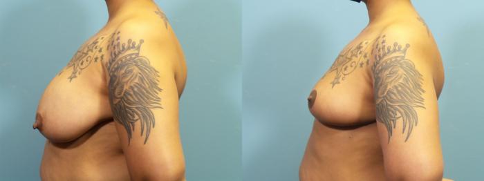Before & After Breast Reconstruction Case 412 Left Side View in Portland, OR