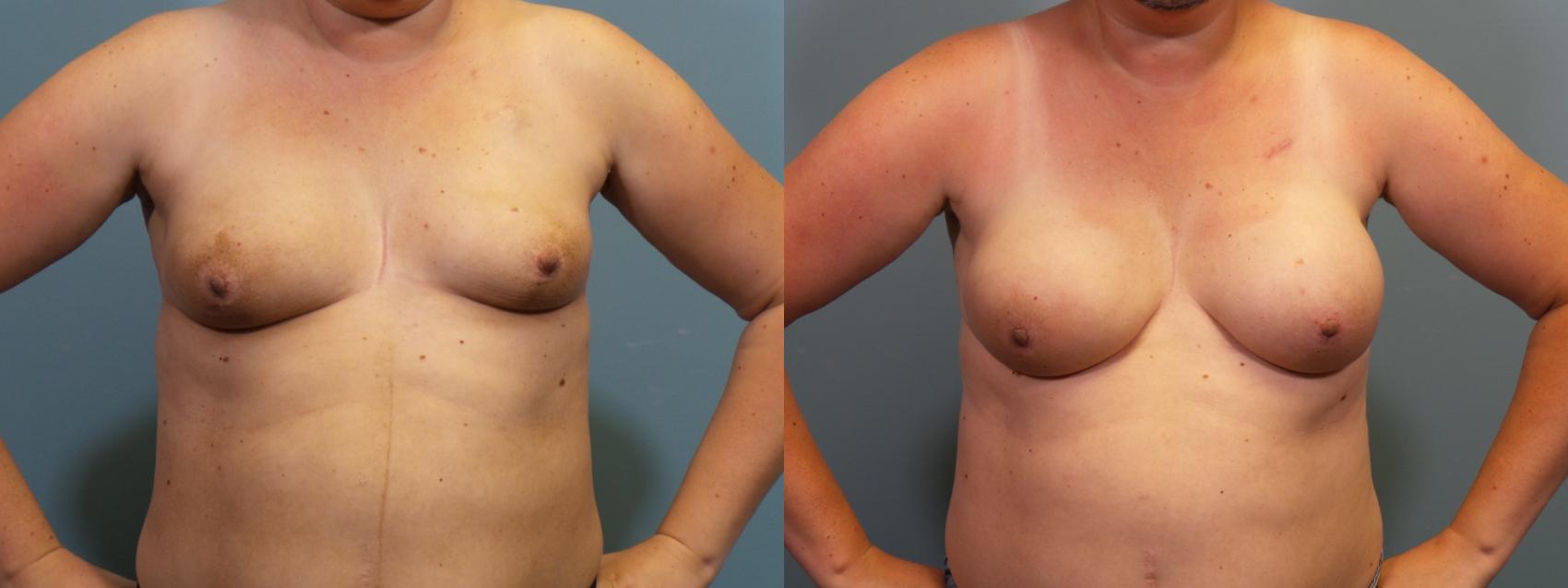 Before & After Breast Reconstruction Case 416 Front View in Portland, OR